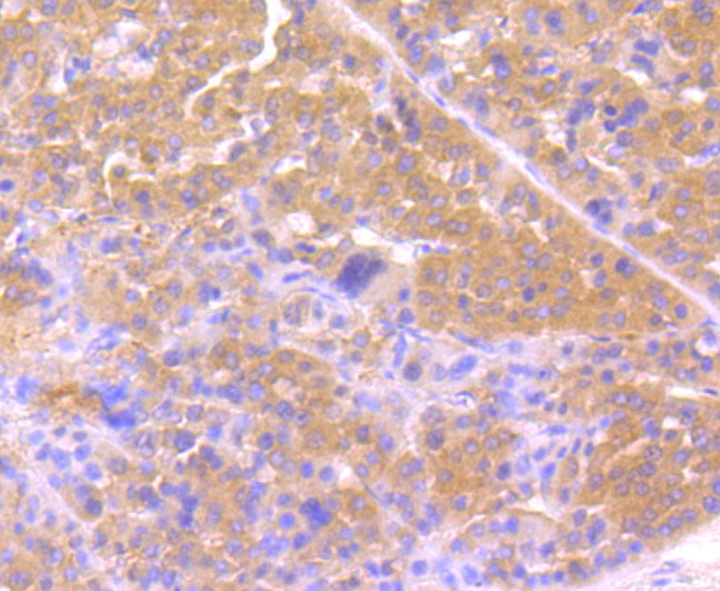 Immunohistochemical analysis of paraffin-embedded human liver cancer tissue using anti-Osteopontin antibody. Counter stained with hematoxylin.