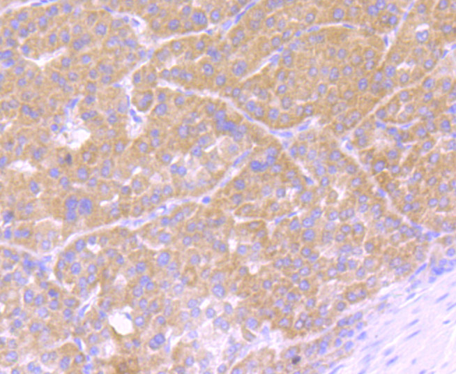 Immunohistochemical analysis of paraffin-embedded human liver cancer tissue using anti-Osteopontin antibody. Counter stained with hematoxylin.