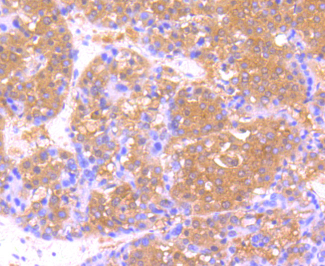 Immunohistochemical analysis of paraffin-embedded human liver cancer tissue using anti-USP21 antibody. Counter stained with hematoxylin.
