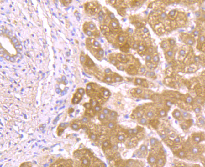 Immunohistochemical analysis of paraffin-embedded human liver tissue using anti-Alpha-1 Acid Glycoprotein antibody. Counter stained with hematoxylin.