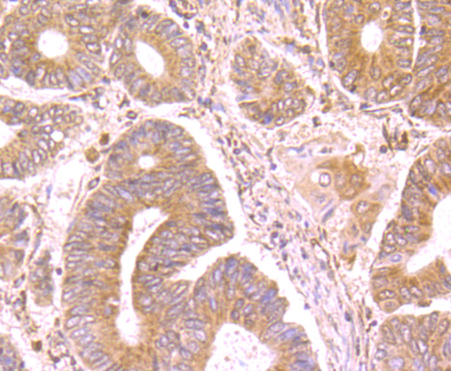 Immunohistochemical analysis of paraffin-embedded human colon cancer tissue using anti-SFRP1 antibody. Counter stained with hematoxylin.