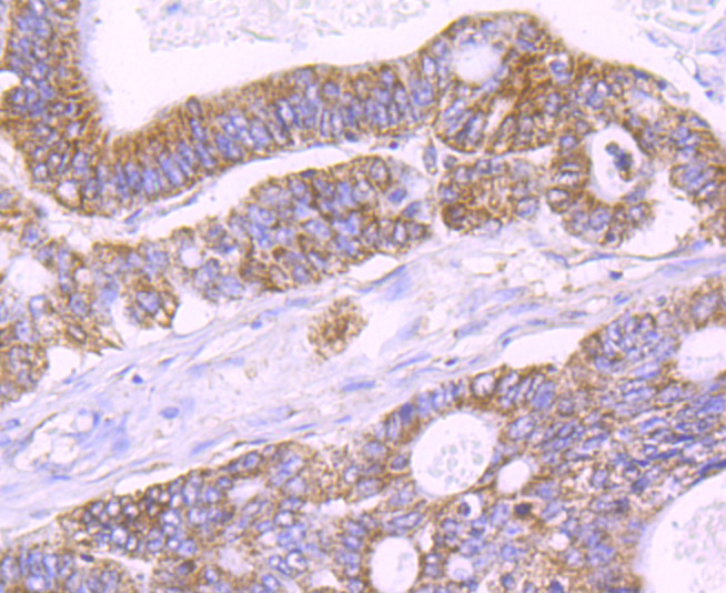 Immunohistochemical analysis of paraffin-embedded human colon cancer tissue using anti-IL1 alpha antibody. Counter stained with hematoxylin.