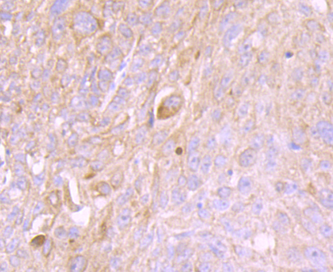 Immunohistochemical analysis of paraffin-embedded human lung cancer tissue using anti-Cytokeratin 8 antibody. Counter stained with hematoxylin.