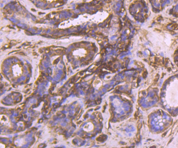 Immunohistochemical analysis of paraffin-embedded human breast cancer tissue using anti-CRMP2 antibody. Counter stained with hematoxylin.