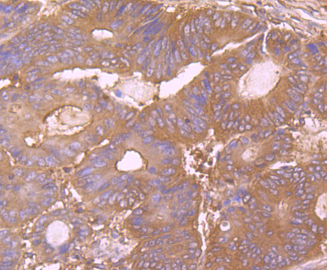 Immunohistochemical analysis of paraffin-embedded human colon cancer tissue using anti-CD55 antibody. Counter stained with hematoxylin.