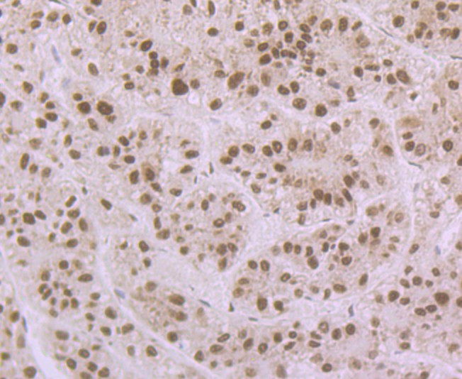 Immunohistochemical analysis of paraffin-embedded human colon tissue using anti-APE1 antibody. Counter stained with hematoxylin.