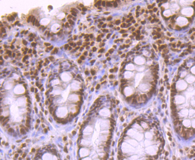 Immunohistochemical analysis of paraffin-embedded human breast cancer tissue using anti-APE1 antibody. Counter stained with hematoxylin.
