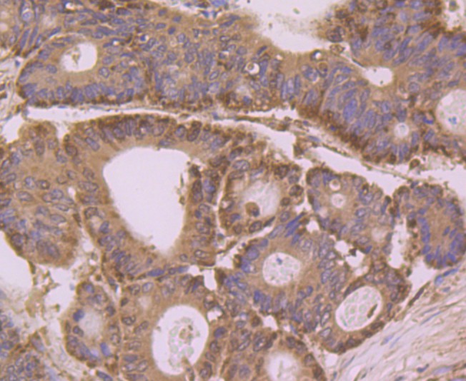 Immunohistochemical analysis of paraffin-embedded human colon cancer tissue using anti-Annexin A3 antibody. Counter stained with hematoxylin.