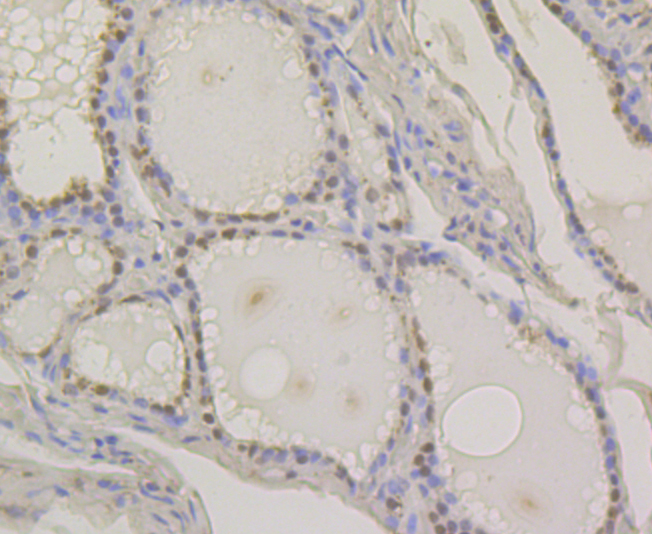 Immunohistochemical analysis of paraffin-embedded human thyroid gland tissue with Rabbit anti-Pax8 antibody (ER1802-51) at 1/400 dilution.<br />
<br />
The section was pre-treated using heat mediated antigen retrieval with sodium citrate buffer (pH 6.0) for 2 minutes. The tissues were blocked in 1% BSA for 20 minutes at room temperature, washed with ddH2O and PBS, and then probed with the primary antibody (ER1802-51) at 1/400 dilution for 1 hour at room temperature. The detection was performed using an HRP conjugated compact polymer system. DAB was used as the chromogen. Tissues were counterstained with hematoxylin and mounted with DPX.