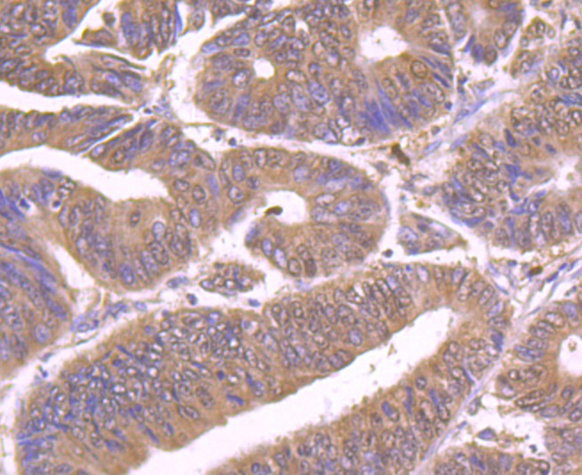 Immunohistochemical analysis of paraffin-embedded human colon cancer tissue using anti-Hip1 antibody. Counter stained with hematoxylin.