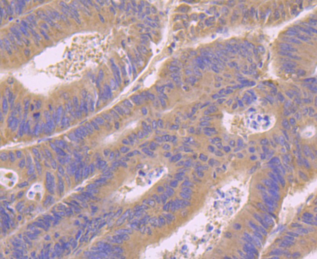 Immunohistochemical analysis of paraffin-embedded human colon cancer tissue using anti-RAB7 antibody. Counter stained with hematoxylin.