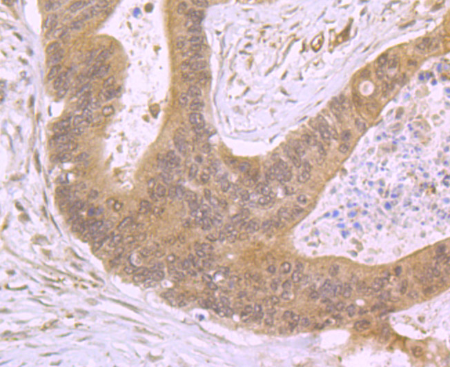 Immunohistochemical analysis of paraffin-embedded human colon cancer tissue using anti-SDF1 antibody. Counter stained with hematoxylin.
