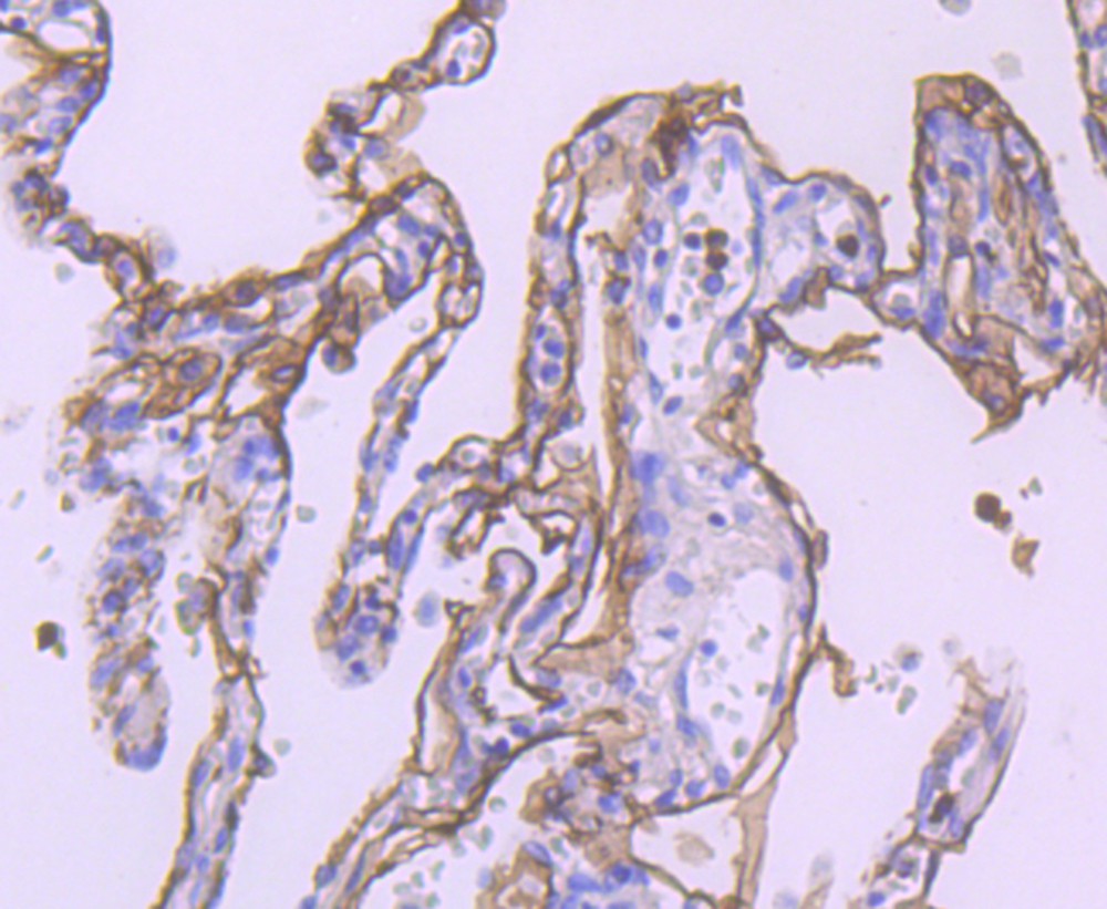 Immunohistochemical analysis of paraffin-embedded human lung carcinoma tissue using anti-TROP2 antibody. The section was pre-treated using heat mediated antigen retrieval with Tris-EDTA buffer (pH 8.0-8.4) for 20 minutes.The tissues were blocked in 5% BSA for 30 minutes at room temperature, washed with ddH2O and PBS, and then probed with the primary antibody (ER1802-60, 1/50) for 30 minutes at room temperature. The detection was performed using an HRP conjugated compact polymer system. DAB was used as the chromogen. Tissues were counterstained with hematoxylin and mounted with DPX.