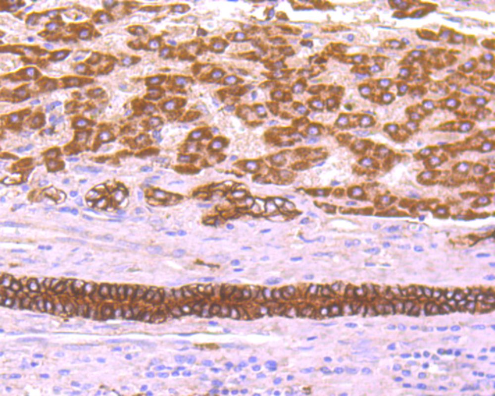Immunohistochemical analysis of paraffin-embedded human liver carcinoma tissue using anti-TROP2 antibody. The section was pre-treated using heat mediated antigen retrieval with Tris-EDTA buffer (pH 8.0-8.4) for 20 minutes.The tissues were blocked in 5% BSA for 30 minutes at room temperature, washed with ddH2O and PBS, and then probed with the primary antibody (ER1802-60, 1/50) for 30 minutes at room temperature. The detection was performed using an HRP conjugated compact polymer system. DAB was used as the chromogen. Tissues were counterstained with hematoxylin and mounted with DPX.