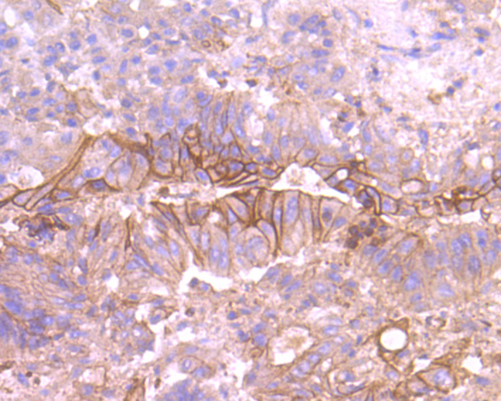 Immunohistochemical analysis of paraffin-embedded human colon carcinoma tissue using anti-TROP2 antibody. The section was pre-treated using heat mediated antigen retrieval with Tris-EDTA buffer (pH 8.0-8.4) for 20 minutes.The tissues were blocked in 5% BSA for 30 minutes at room temperature, washed with ddH2O and PBS, and then probed with the primary antibody (ER1802-60, 1/50) for 30 minutes at room temperature. The detection was performed using an HRP conjugated compact polymer system. DAB was used as the chromogen. Tissues were counterstained with hematoxylin and mounted with DPX.