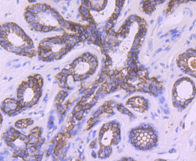 Immunohistochemical analysis of paraffin-embedded human breast carcinoma tissue using anti-TROP2 antibody. The section was pre-treated using heat mediated antigen retrieval with Tris-EDTA buffer (pH 8.0-8.4) for 20 minutes.The tissues were blocked in 5% BSA for 30 minutes at room temperature, washed with ddH2O and PBS, and then probed with the primary antibody (ER1802-60, 1/50) for 30 minutes at room temperature. The detection was performed using an HRP conjugated compact polymer system. DAB was used as the chromogen. Tissues were counterstained with hematoxylin and mounted with DPX.