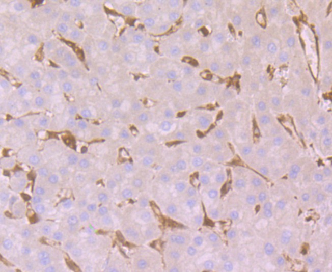 Immunohistochemical analysis of paraffin-embedded human liver cancer tissue using anti-GST3 antibody. Counter stained with hematoxylin.