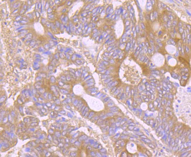 Immunohistochemical analysis of paraffin-embedded human colon cancer tissue using anti-TWEAKR antibody. Counter stained with hematoxylin.