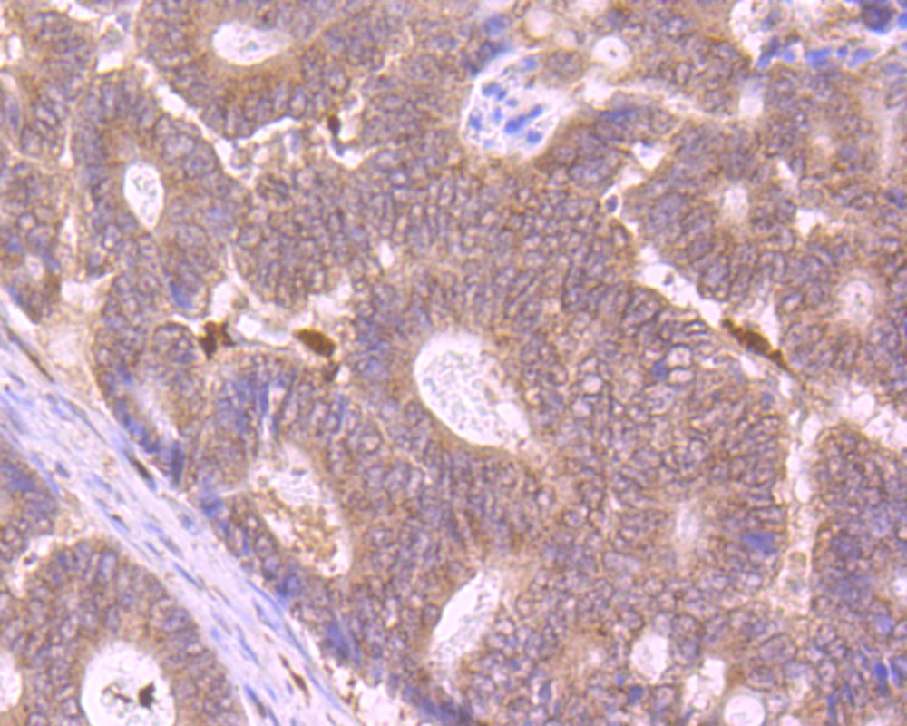 Immunohistochemical analysis of paraffin-embedded human colon cancer tissue using anti-SUFU antibody. Counter stained with hematoxylin.