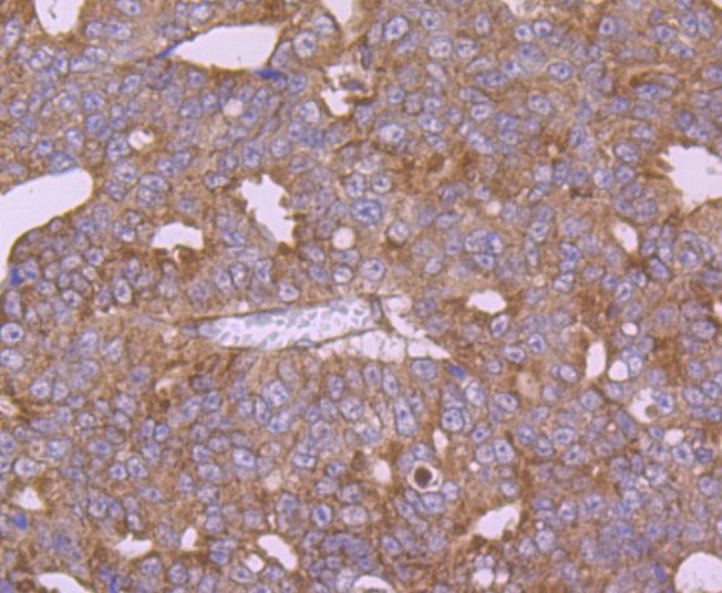 Immunohistochemical analysis of paraffin-embedded human thyroid gland cancer tissue using anti-CTGF antibody. Counter stained with hematoxylin.