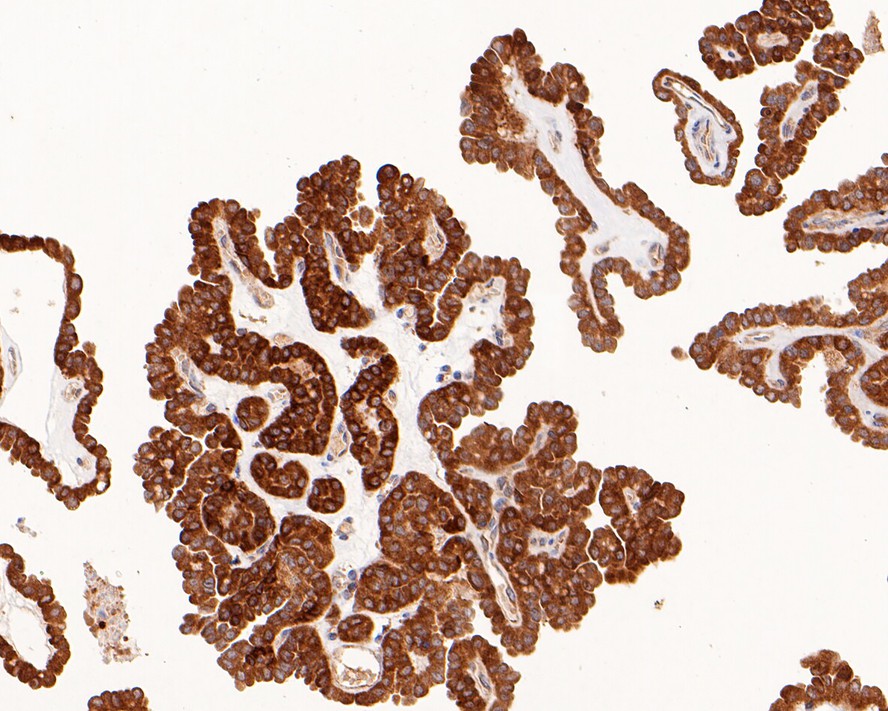 Immunohistochemical analysis of paraffin-embedded human thyroid carcinoma tissue with Rabbit anti-PKM2 antibody (ER1802-70) at 1/400 dilution.<br />
<br />
The section was pre-treated using heat mediated antigen retrieval with sodium citrate buffer (pH 6.0) for 2 minutes. The tissues were blocked in 1% BSA for 20 minutes at room temperature, washed with ddH2O and PBS, and then probed with the primary antibody (ER1802-70) at 1/400 dilution for 1 hour at room temperature. The detection was performed using an HRP conjugated compact polymer system. DAB was used as the chromogen. Tissues were counterstained with hematoxylin and mounted with DPX.