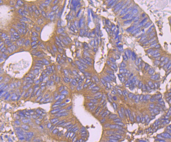Immunohistochemical analysis of paraffin-embedded human colon cancer tissue using anti-PKM2 antibody. Counter stained with hematoxylin.