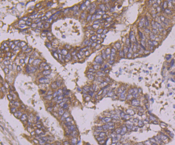 Immunohistochemical analysis of paraffin-embedded human colon cancer tissue using anti-Apg3 antibody. Counter stained with hematoxylin.