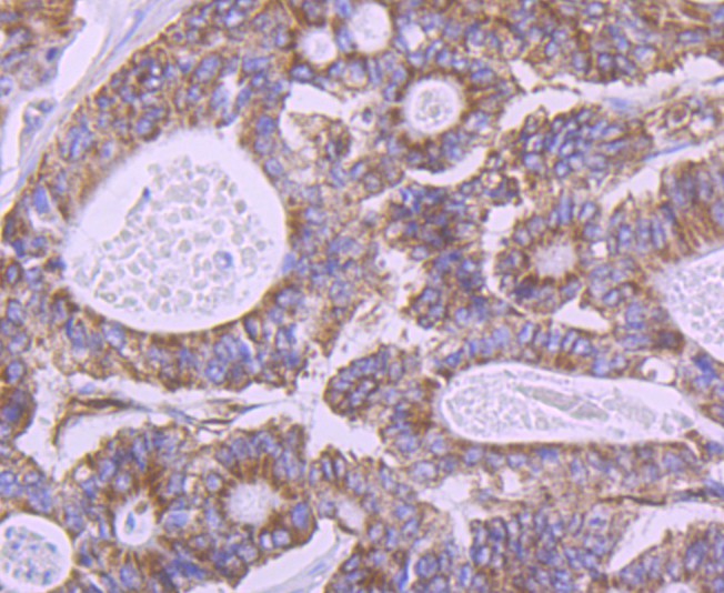 Immunohistochemical analysis of paraffin-embedded human colon cancer tissue using anti-Carbonic anhydrase 2 antibody. Counter stained with hematoxylin.