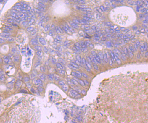 Immunohistochemical analysis of paraffin-embedded human colon cancer tissue using anti-EpCAM antibody. Counter stained with hematoxylin.