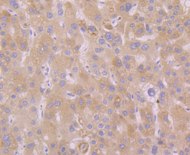 Immunohistochemical analysis of paraffin-embedded human liver cancer tissue using anti-Atg12 antibody. Counter stained with hematoxylin.