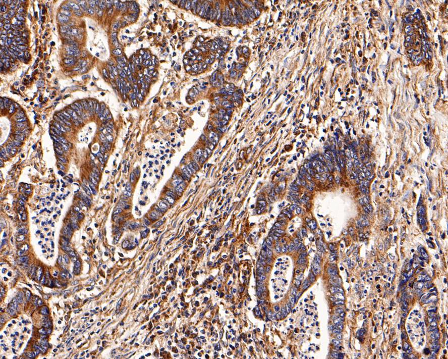 Immunohistochemical analysis of paraffin-embedded human colon carcinoma tissue with Rabbit anti-PTP1B antibody (ER1802-83) at 1/1,000 dilution.<br />
<br />
The section was pre-treated using heat mediated antigen retrieval with Tris-EDTA buffer (pH 9.0) for 20 minutes. The tissues were blocked in 1% BSA for 20 minutes at room temperature, washed with ddH2O and PBS, and then probed with the primary antibody (ER1802-83) at 1/1,000 dilution for 1 hour at room temperature. The detection was performed using an HRP conjugated compact polymer system. DAB was used as the chromogen. Tissues were counterstained with hematoxylin and mounted with DPX.