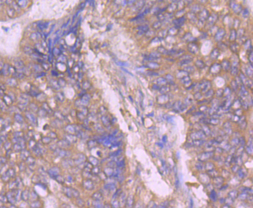 Immunohistochemical analysis of paraffin-embedded human colon cancer tissue using anti-ASK1 antibody. Counter stained with hematoxylin.