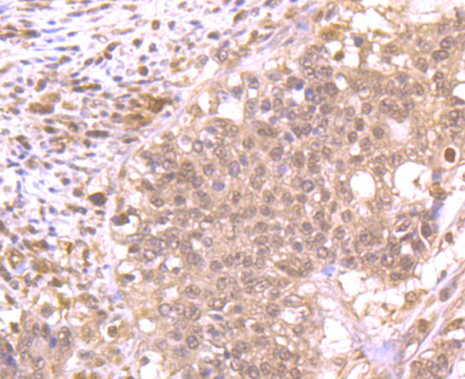 Immunohistochemical analysis of paraffin-embedded human stomach cancer tissue using anti-RBX1 antibody. Counter stained with hematoxylin.