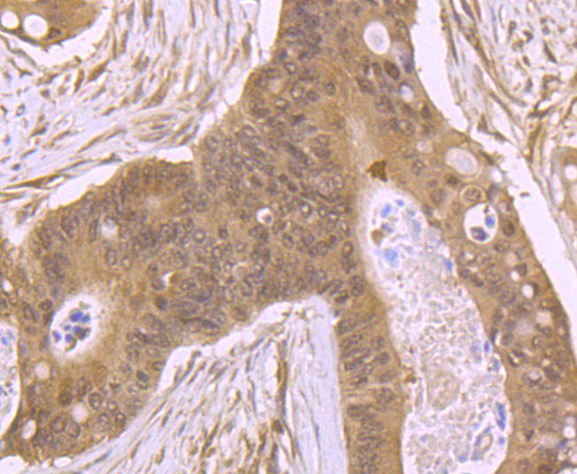 Immunohistochemical analysis of paraffin-embedded human colon cancer tissue using anti-RBX1 antibody. Counter stained with hematoxylin.