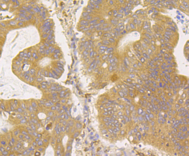 Immunohistochemical analysis of paraffin-embedded human colon cancer tissue using anti-ERGI3 antibody. Counter stained with hematoxylin.