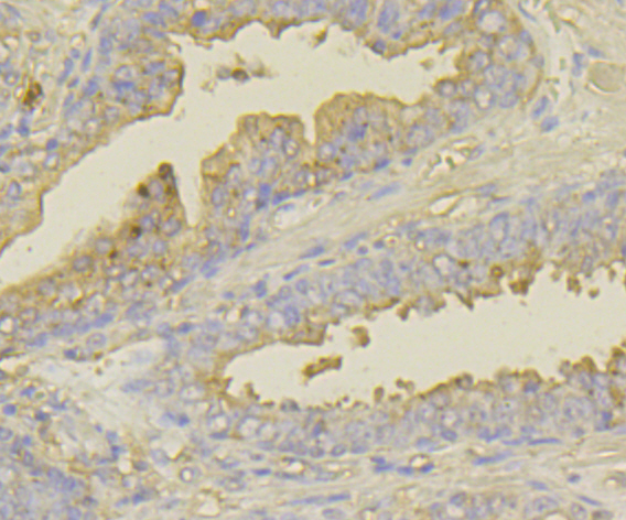 Immunohistochemical analysis of paraffin-embedded human prostate cancer tissue using anti-UAP1 antibody. Counter stained with hematoxylin.