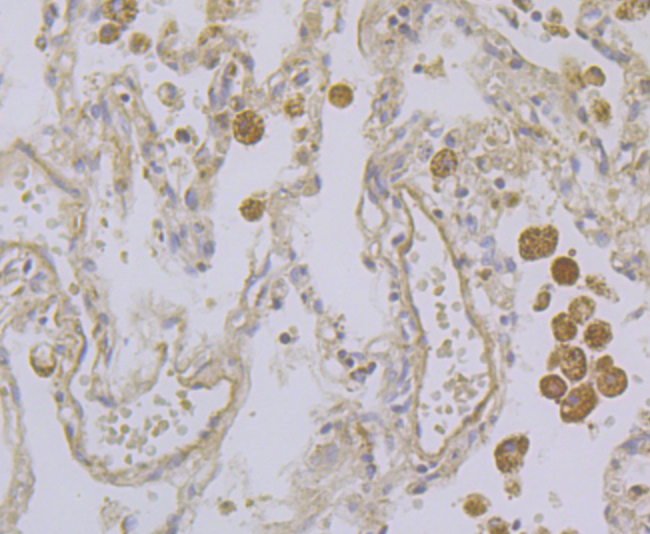 Immunohistochemical analysis of paraffin-embedded human lung cancer tissue using anti-Kir3.4 antibody. Counter stained with hematoxylin.