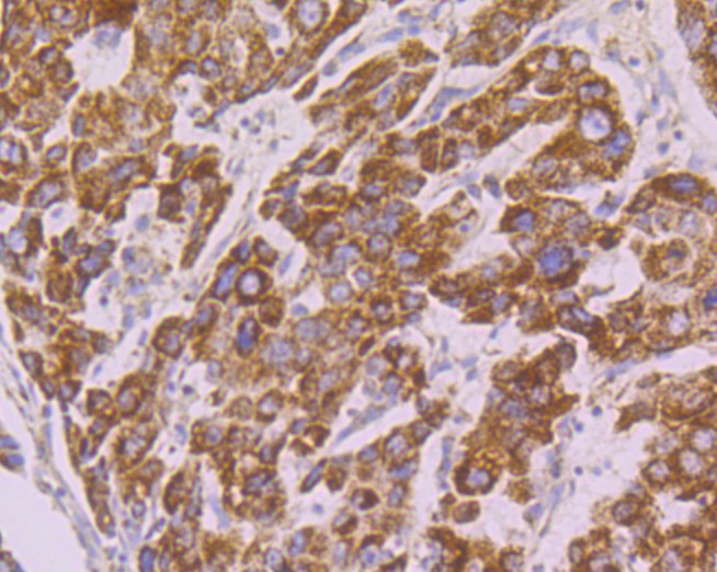 Immunohistochemical analysis of paraffin-embedded human liver carcinoma tissue using anti-Tyk2 antibody. The section was pre-treated using heat mediated antigen retrieval with Tris-EDTA buffer (pH 9.0) for 20 minutes.The tissues were blocked in 1% BSA for 30 minutes at room temperature, washed with ddH2O and PBS, and then probed with the primary antibody (ER1803-05, 1/50) for 30 minutes at room temperature. The detection was performed using an HRP conjugated compact polymer system. DAB was used as the chromogen. Tissues were counterstained with hematoxylin and mounted with DPX.