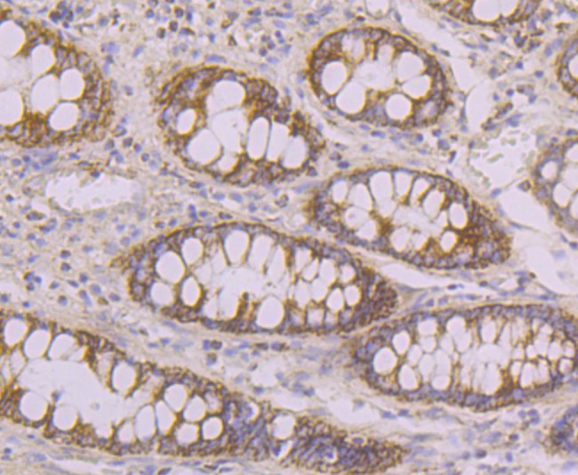Immunohistochemical analysis of paraffin-embedded human colon tissue using anti-Tyk2 antibody. The section was pre-treated using heat mediated antigen retrieval with Tris-EDTA buffer (pH 9.0) for 20 minutes.The tissues were blocked in 1% BSA for 30 minutes at room temperature, washed with ddH2O and PBS, and then probed with the primary antibody (ER1803-05, 1/50) for 30 minutes at room temperature. The detection was performed using an HRP conjugated compact polymer system. DAB was used as the chromogen. Tissues were counterstained with hematoxylin and mounted with DPX.