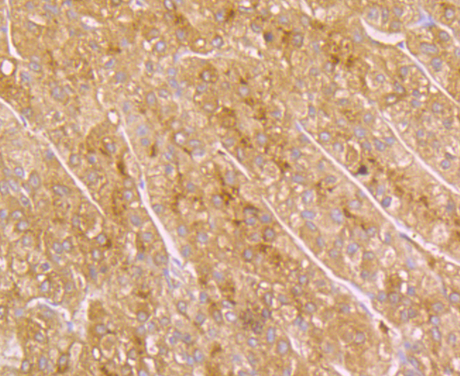 Immunohistochemical analysis of paraffin-embedded human liver tissue using anti-SERPINC1 antibody. Counter stained with hematoxylin.