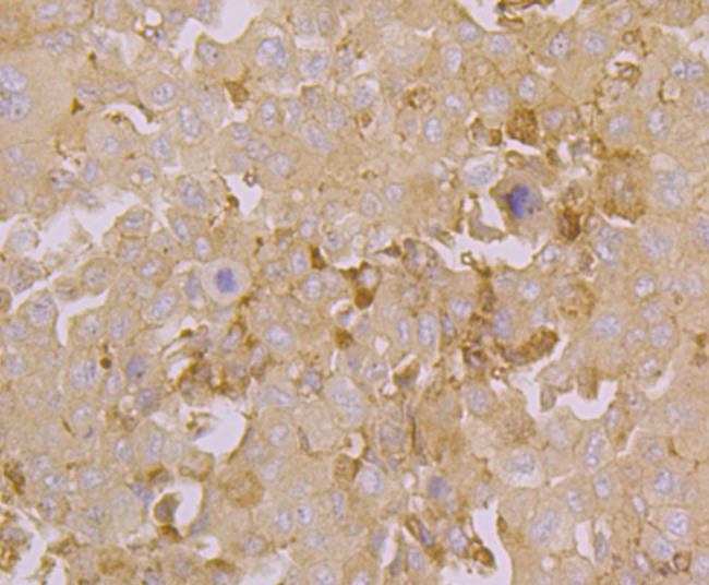 Immunohistochemical analysis of paraffin-embedded human liver cancer tissue using anti-Orai3 antibody. Counter stained with hematoxylin.
