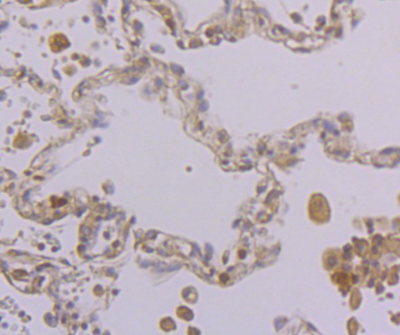 Immunohistochemical analysis of paraffin-embedded human lung cancer tissue using anti-Eg5 antibody. Counter stained with hematoxylin.
