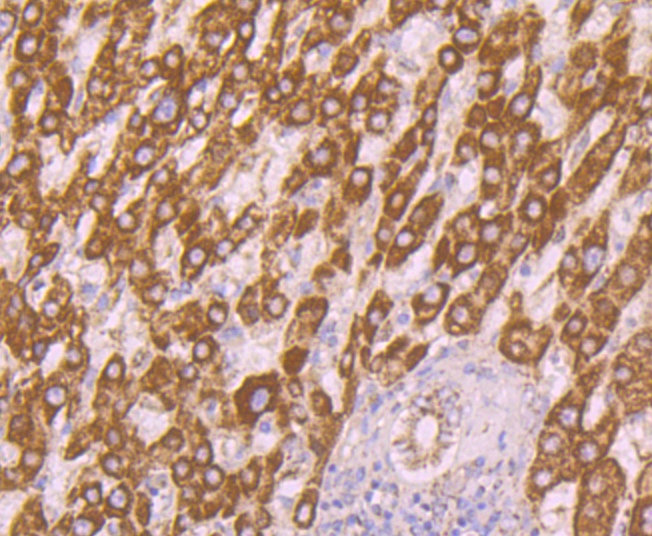 Immunohistochemical analysis of paraffin-embedded human liver cancer tissue using anti-AMBP antibody. Counter stained with hematoxylin.