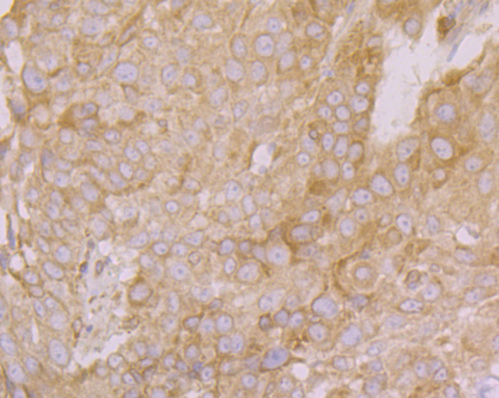 Immunohistochemical analysis of paraffin-embedded human lung cancer tissue using anti-PHF8 antibody. Counter stained with hematoxylin.