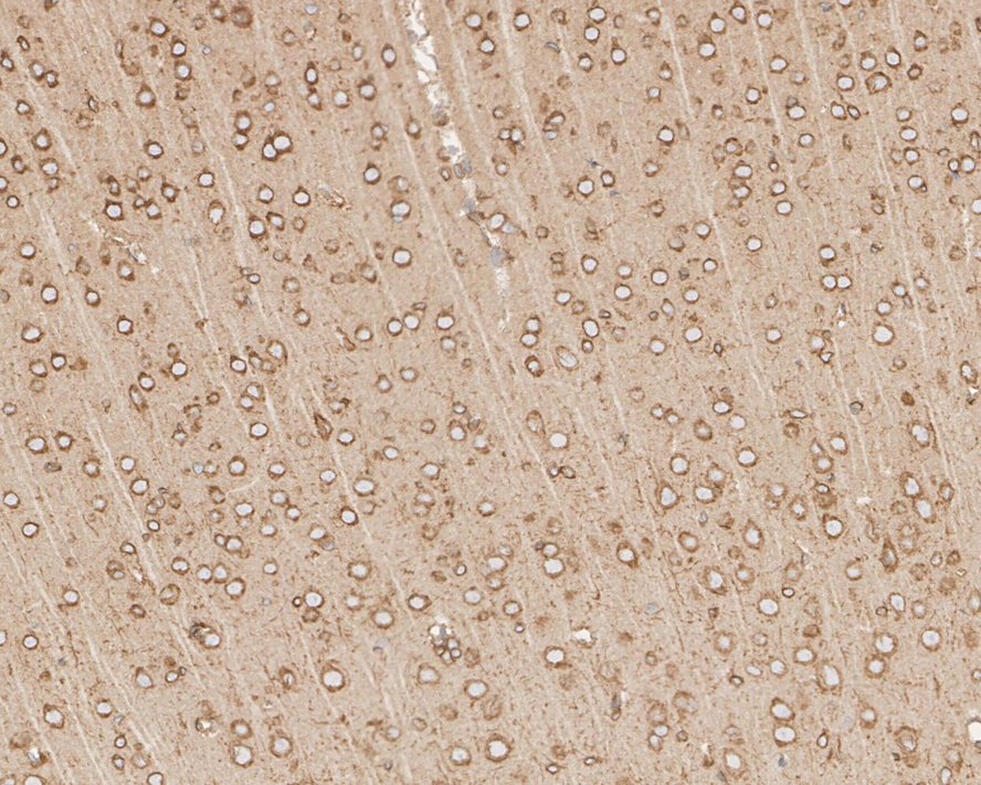 Immunohistochemical analysis of paraffin-embedded human breast cancer tissue using anti-Calnexin antibody. Counter stained with hematoxylin.
