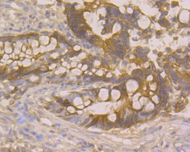 Immunohistochemical analysis of paraffin-embedded human colon cancer tissue using anti-CDKN2A/p16INK4a antibody. Counter stained with hematoxylin. The section was pre-treated using heat mediated antigen retrieval with sodium citrate buffer (pH6) for 20 mins.
