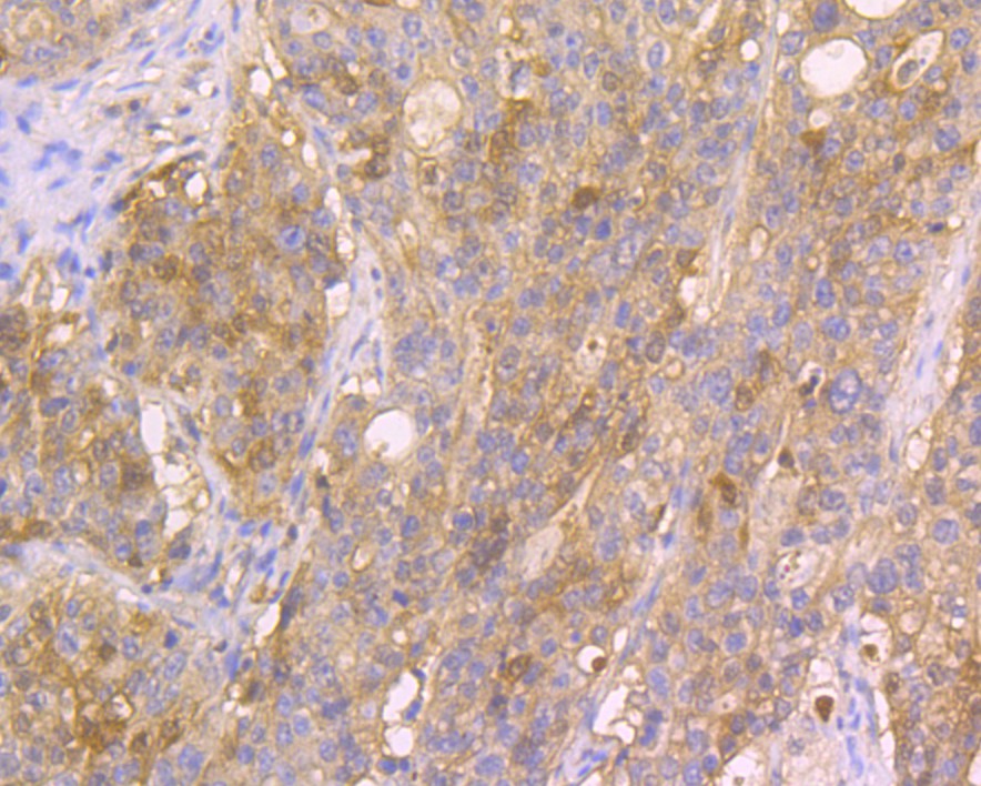 Immunohistochemical analysis of paraffin-embedded human stomach cancer tissue using anti-CDKN2A/p16INK4a antibody. Counter stained with hematoxylin. The section was pre-treated using heat mediated antigen retrieval with sodium citrate buffer (pH6) for 20 mins.