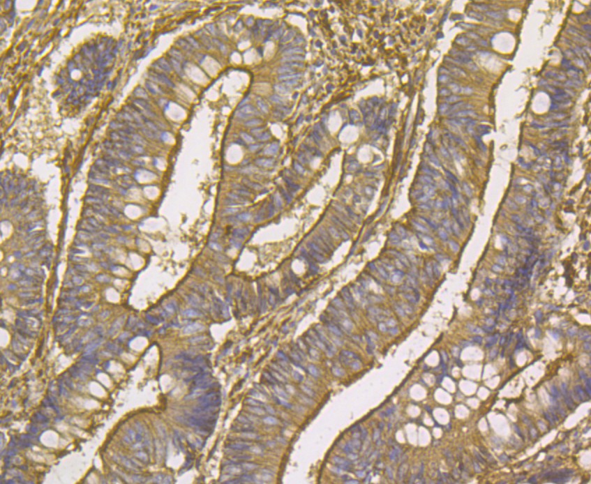 Immunohistochemical analysis of paraffin-embedded human colon cancer tissue using anti-alpha Actinin antibody. Counter stained with hematoxylin.