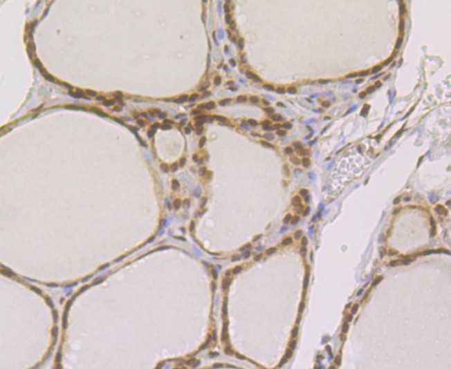 Immunohistochemical analysis of paraffin-embedded human thyroid gland carcinoma tissue using anti-Rad21 antibody. The section was pre-treated using heat mediated antigen retrieval with sodium citrate buffer (pH 6.0) for 20 minutes. The tissues were blocked in 1% BSA for 30 minutes at room temperature, washed with ddH2O and PBS, and then probed with the primary antibody (ER1803-73, 1/200)  for 30 minutes at room temperature. The detection was performed using an HRP conjugated compact polymer system. DAB was used as the chromogen. Tissues were counterstained with hematoxylin and mounted with DPX.