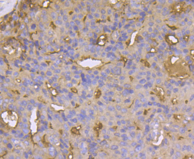 Immunohistochemical analysis of paraffin-embedded human prostate cancer tissue using anti-CD13 antibody. The section was pre-treated using heat mediated antigen retrieval with Tris-EDTA buffer (pH 8.0-8.4) for 20 minutes.The tissues were blocked in 5% BSA for 30 minutes at room temperature, washed with ddH2O and PBS, and then probed with the antibody (ER1803-74) at 1/50 dilution, for 30 minutes at room temperature and detected using an HRP conjugated compact polymer system. DAB was used as the chrogen. Counter stained with hematoxylin and mounted with DPX.